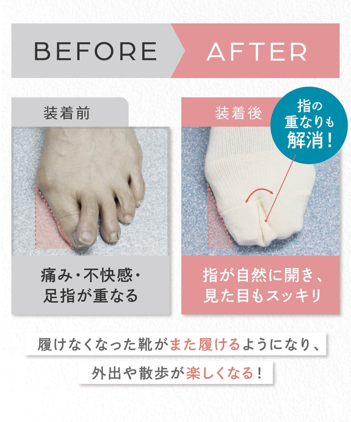 外反母趾ソックス、指の重なりの解消ビフォーアフター